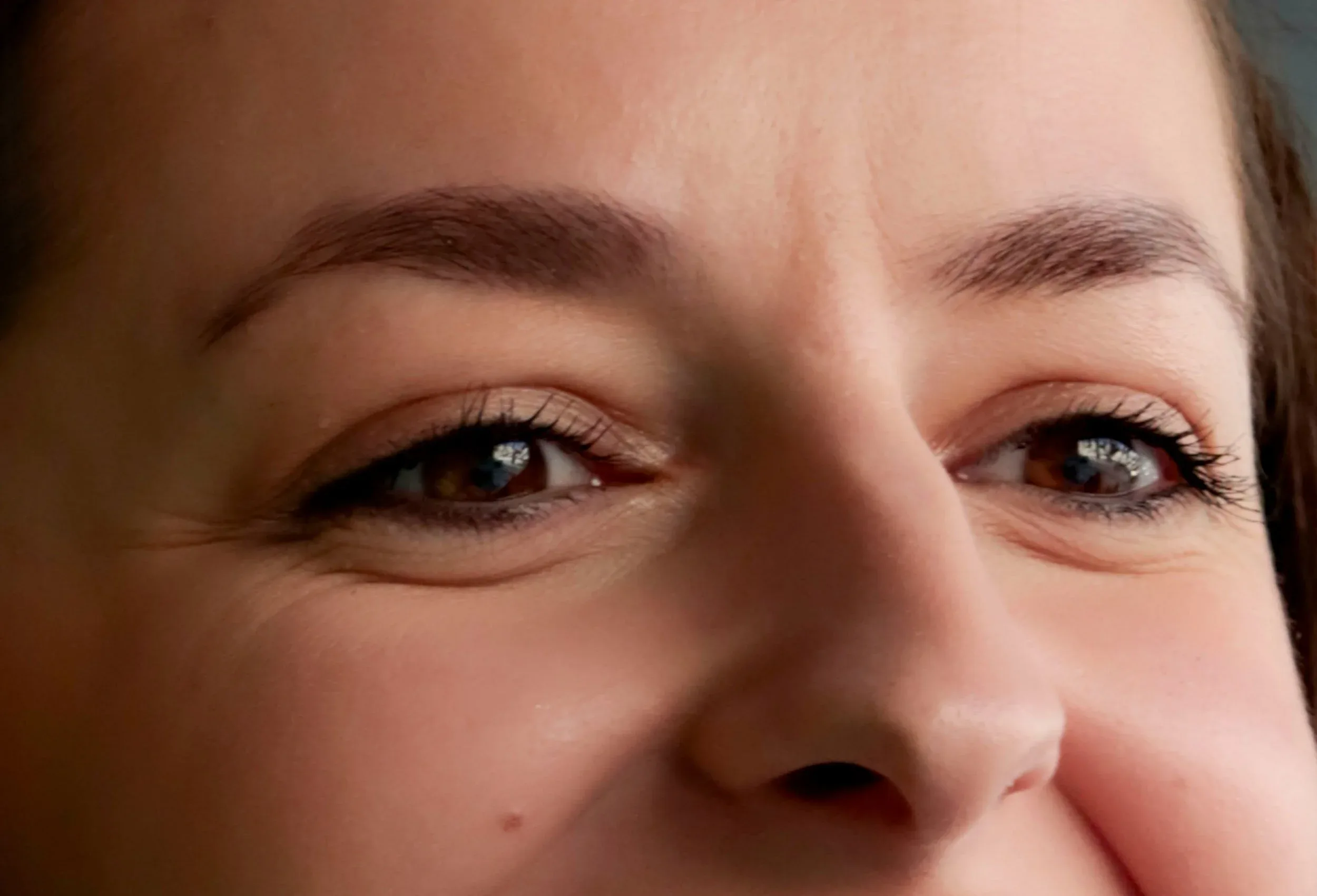 Lower Lid Blepharoplasty