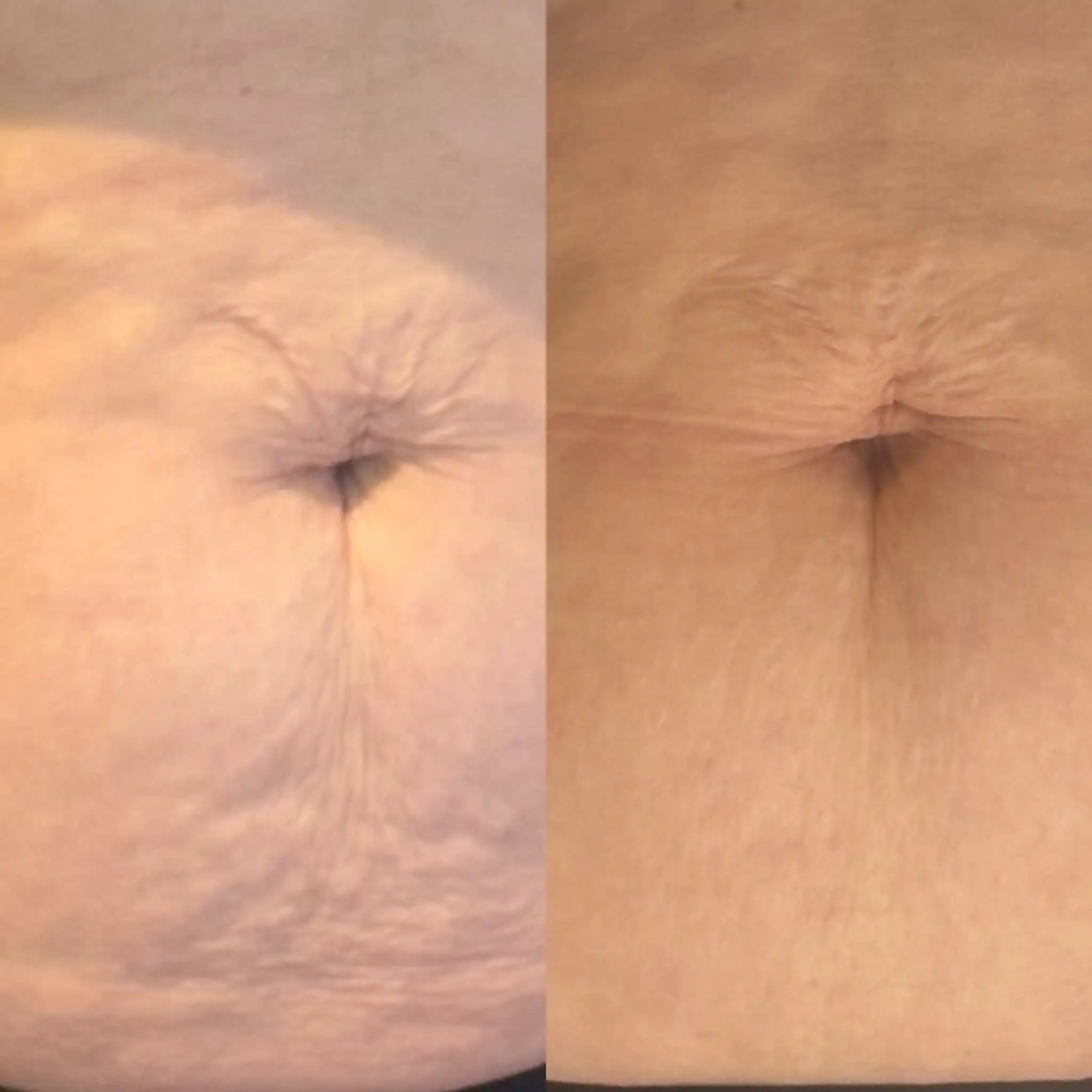 SkinPen Microneedling Before and After