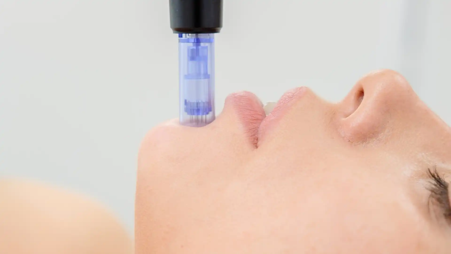 SkinPen Microneedling Scotland